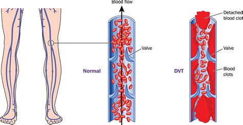 What is deep vein thrombosis (DVT)? :: Agency for Services to Medical ...