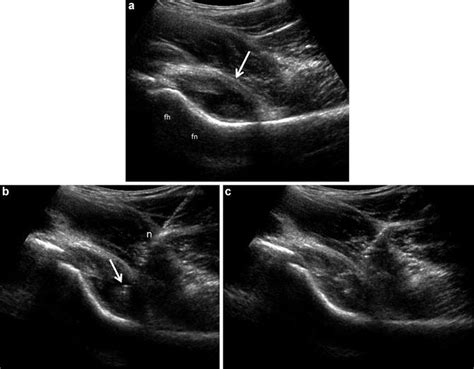 Ultrasound of the Hip | Musculoskeletal Key