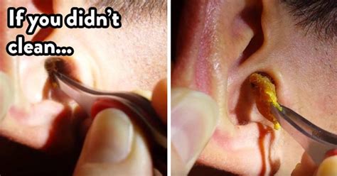 The Best Way To Unblock Clogged Ears Quickly With These Easy Home ...