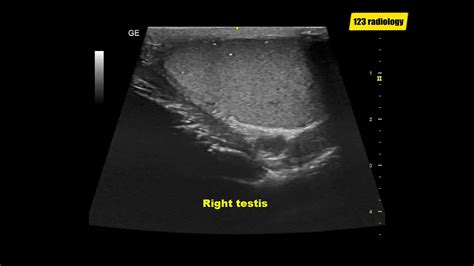 Testicular microlithiasis | Ultrasound Case | GU | - YouTube