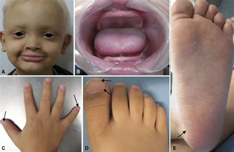 Hypohidrotic ectodermal dysplasia causes, symptoms, diagnosis & treatment