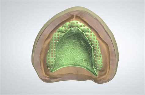 Partial Denture/Frame designs - CADcer