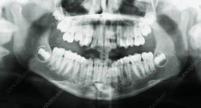 Supernumerary tooth, X-ray - Stock Image - C028/8974 - Science Photo Library