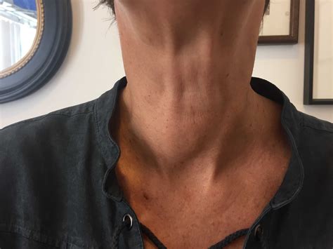 Is this what your neck looks like? Is the goiter giving you symptoms ...