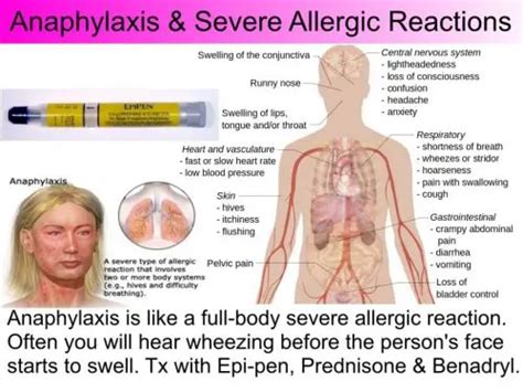 Anaphylactic Shock - In-Pulse CPR