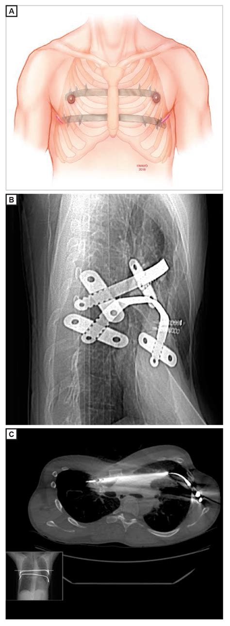 Pectus Excavatum: A Review of Diagnosis and Current Treatment Options