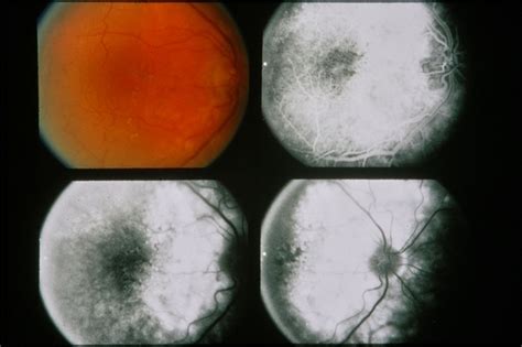 Central Serous Retinopathy - Retina Image Bank