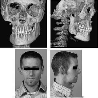 (PDF) Multimodal Treatment of Osteogenic Sarcoma of the Jaw