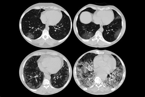 COVID-19 and chest CT | IAEA