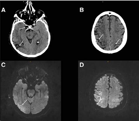 CT and MRI in cerebral air embolism. The initial head CT shows air... | Download Scientific Diagram