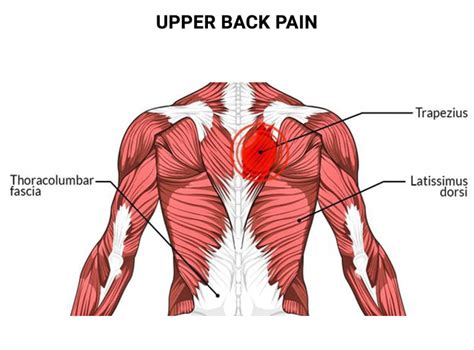 Upper Back Pain Doctors NJ & NYC | Back Pain & Injury Treatments