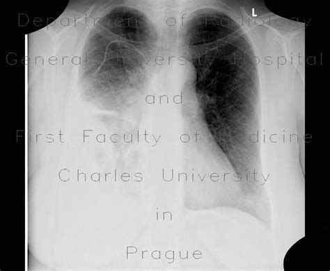 Radiology case: Pneumonia, consolidation