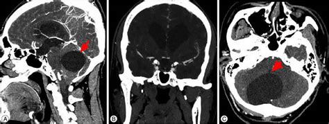 [View 44+] 43+ Posterior Fossa Arachnoid Cyst Pictures GIF