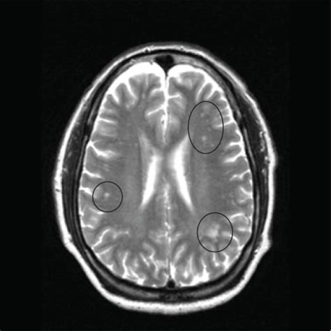 MRI image of the brain in an axial view showing the “ | OPENi