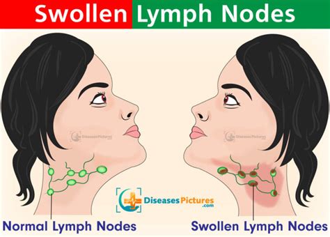 Swollen Lymph Nodes - Symptoms, Causes, In Neck, In Groin, Treatment ...