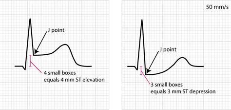 Figure 2. Examples of measuring ST segment elevation and depression ...