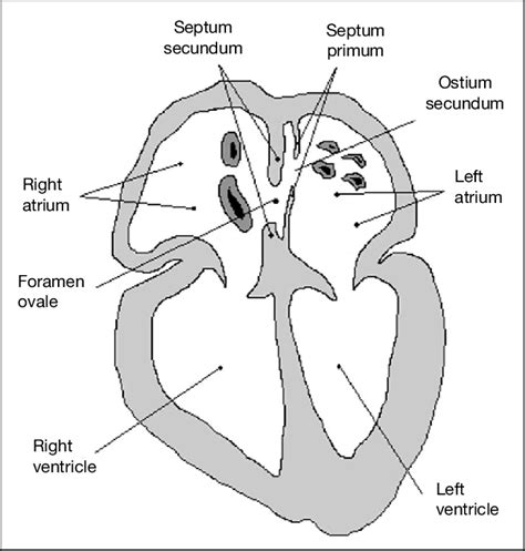 The adult heart with a patent foramen ovale in cross-sectional plane.... | Download Scientific ...