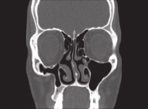 CT scan of paranasal sinus, 3 months postoperative coronal view showing... | Download Scientific ...