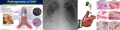 Ventilator Associated Pneumonia Xray