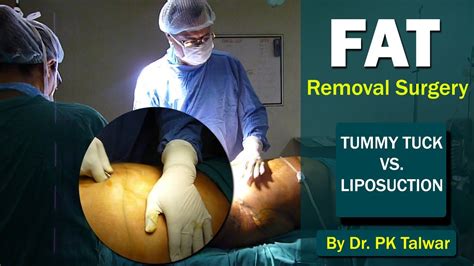 Fat Removal Surgery | Liposuction Vs. Tummy Tuck | Best Fat Removal Surgery in Delhi | Dr. PK ...