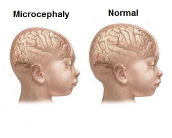 Microcephaly Causes, Symptoms, Diagnosis and Treatment - Natural Health ...