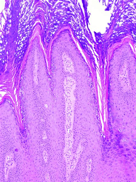 Filiform Wart Histology