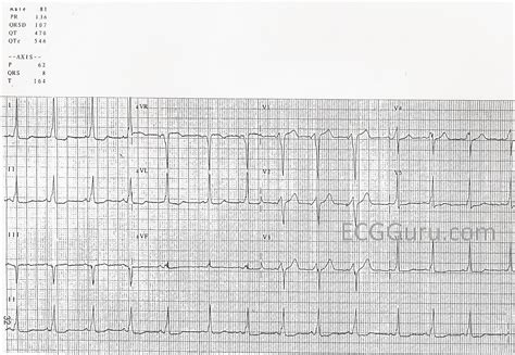 Wolff-Parkinson-White Syndrome | ECG Guru - Instructor Resources