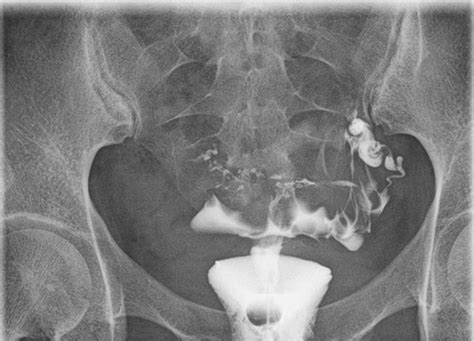 Salpingitis isthmica nodosa | Radiology Case | Radiopaedia.org | Radiology, Oral pathology ...