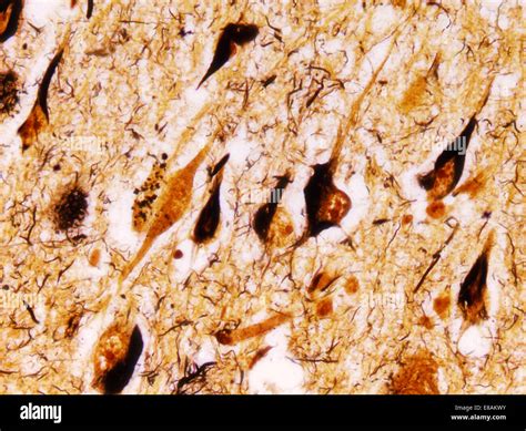 Neurofibrillary tangles hi-res stock photography and images - Alamy