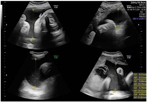 Children | Free Full-Text | Amniotic Fluid Disorders: From Prenatal Management to Neonatal Outcomes