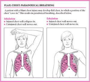 paradoxical: paradoxical breathing