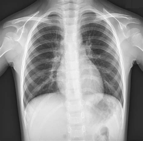 Neat How To Report Normal Chest X Ray Write A Good Introduction For Research