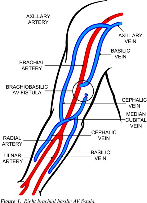 Figure 1 from AXILLARY ARTERY BRACHIAL ARTERY RADIAL ARTERY ULNAR ARTERY AXILLARY VEIN BASILIC ...