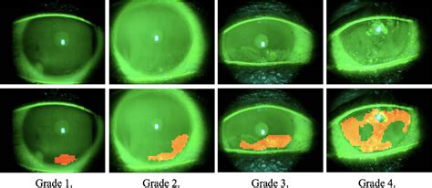 Figure 1 from Superficial Punctate Keratitis Grading for Dry Eye Screening Using Deep ...