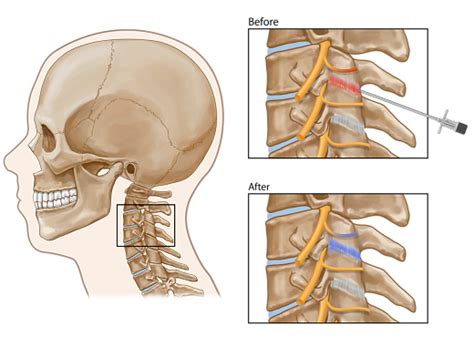 Cervical Facet Joint Injection | Chronic Neck Pain Treatment | Pain Spa ...