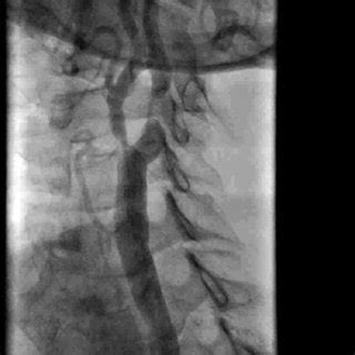 Tight stenosis of right internal carotid artery | Download Scientific Diagram