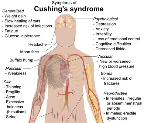 Cushing's Syndrome - almostadoctor