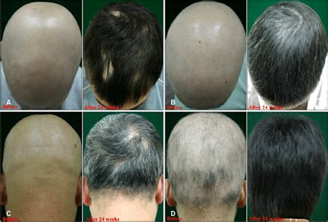 Alopecia Universalis Treatment