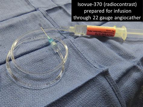 Sialogram Technique | Iowa Head and Neck Protocols