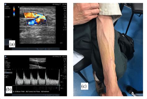 Fistula On Ultrasound