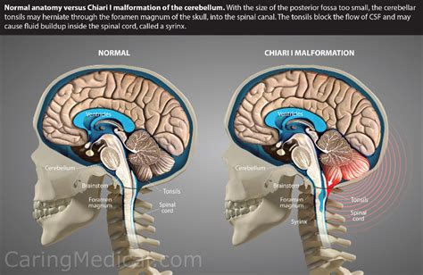 Cerebellar tonsillar ectopia herniation and Chiari 1 malformation: Non-surgical alternatives to ...