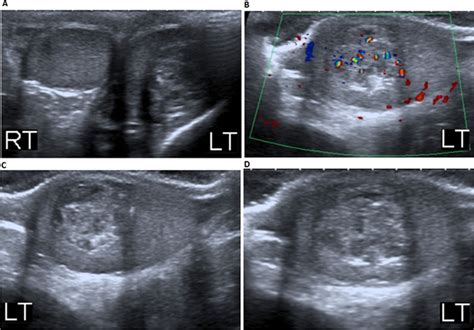 Paediatric benign cystic monodermal testicular teratoma | BMJ Case Reports