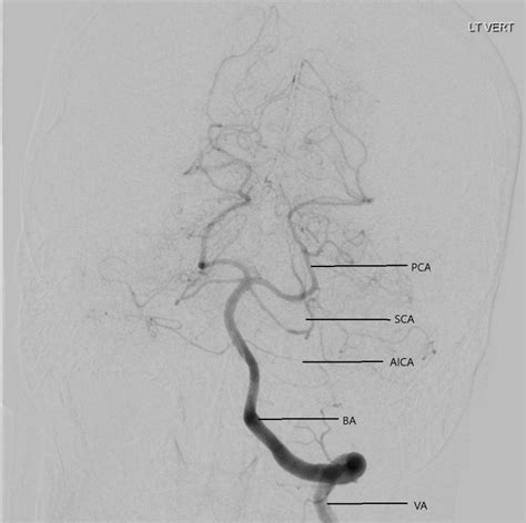 [Figure, Digital Subtraction Angiogram of the...] - StatPearls - NCBI ...