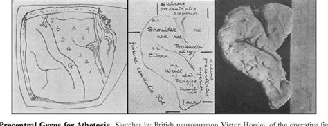 Figure 9 from Early Controversies Over Athetosis: II. Treatment | Semantic Scholar