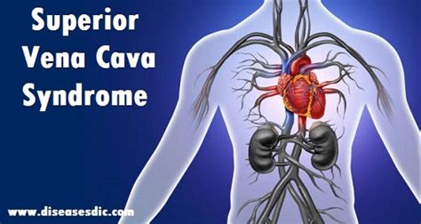 Superior Vena Cava Syndrome (SVCS) – Causes and Treatment