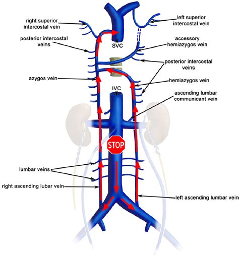 Figure 7 from Congenital absence of inferior vena cava. | Semantic Scholar