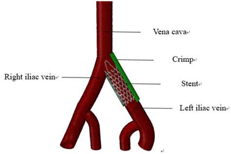 Study on mechanical properties of new iliac vein stent in different stenotic vessels - Risu Na ...