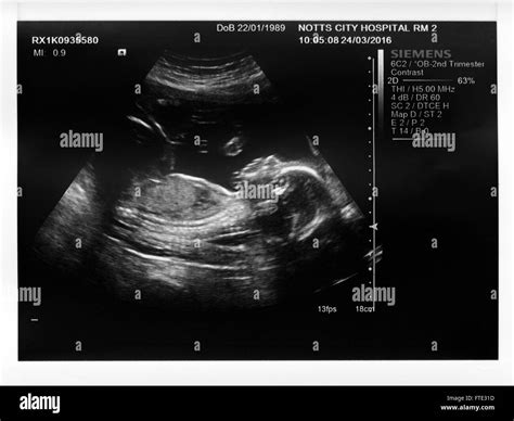 Ultrasound Baby Boy High Resolution Stock Photography and Images - Alamy