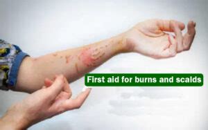 First aid for - Burns & Scalds - Health Vision