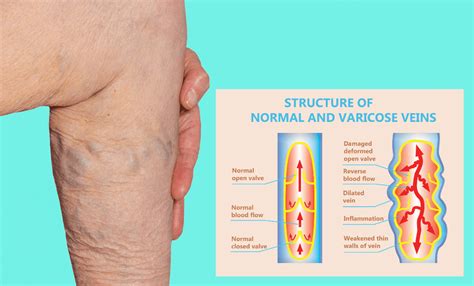 Superficial Vein Thrombosis Toronto Ontario 2 | Canada Vein Clinics